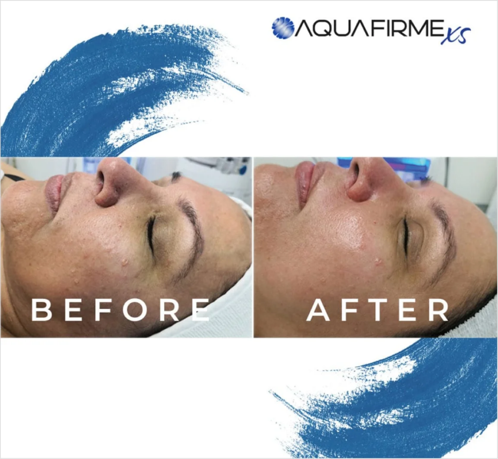 before and after photos of Aquafirme treatment Atomic Dermatology and Med Spa