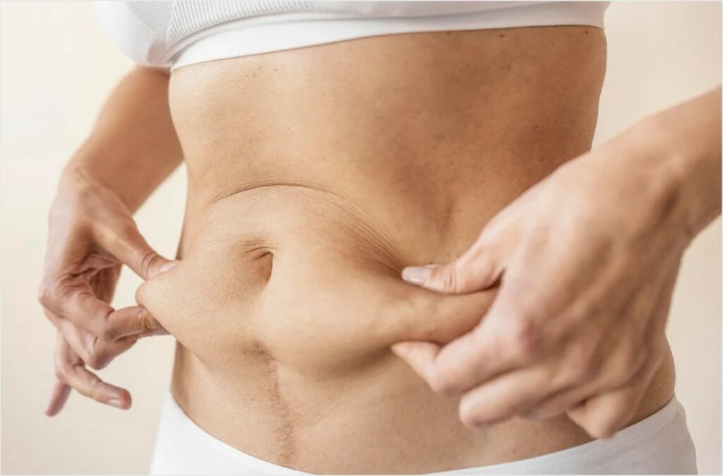 a photo of unwanted fat that can be removed using CoolSculpting procedure at Atomic Dermatology and Med Spa