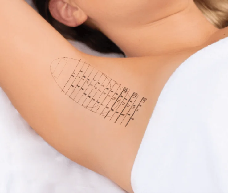 marking the underarm for MiraDry treatment preparation Atomic Dermatology and Med Spa