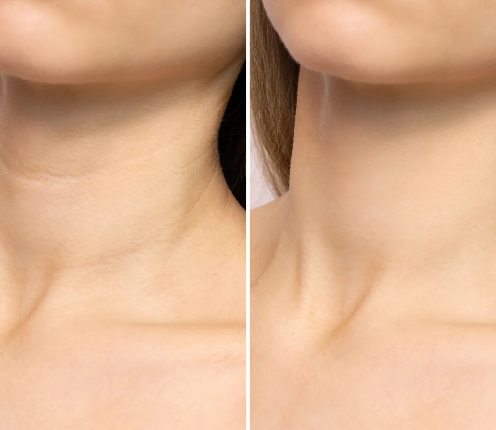 before and after photo of Scarlet RF neck treatment Atomic Dermatology and Med Spa