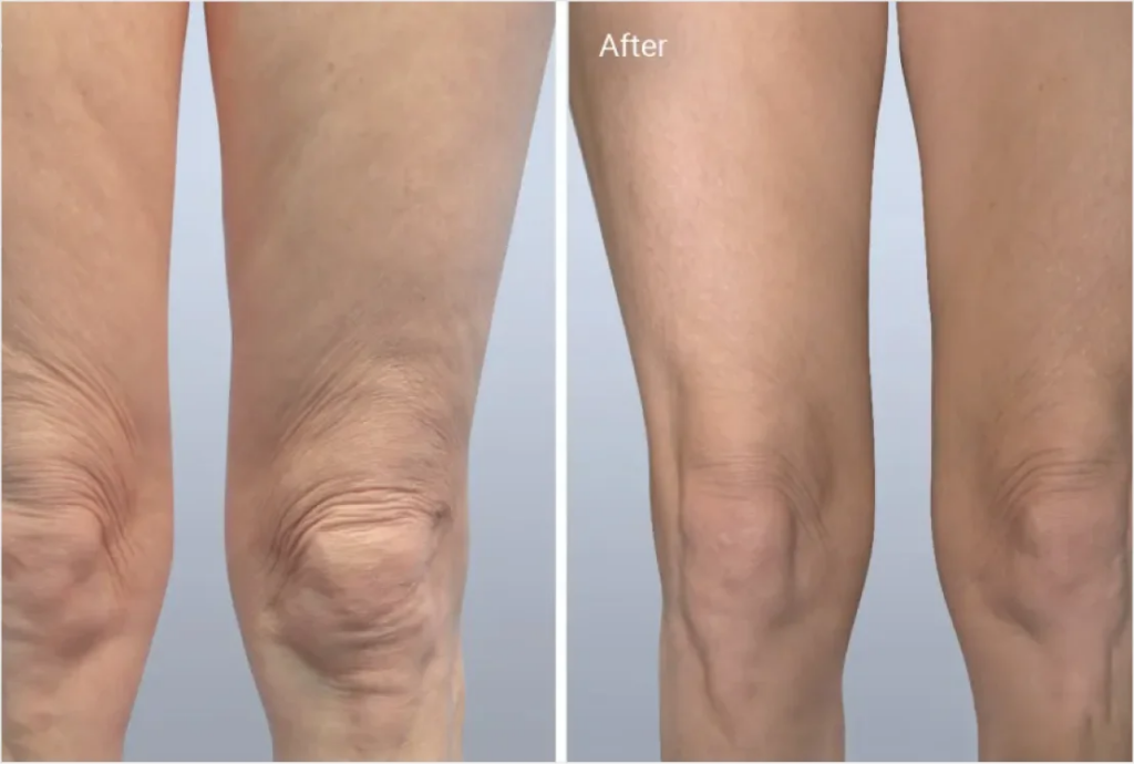 before and after photo of Scarlet RF legs treatment Atomic Dermatology and Med Spa