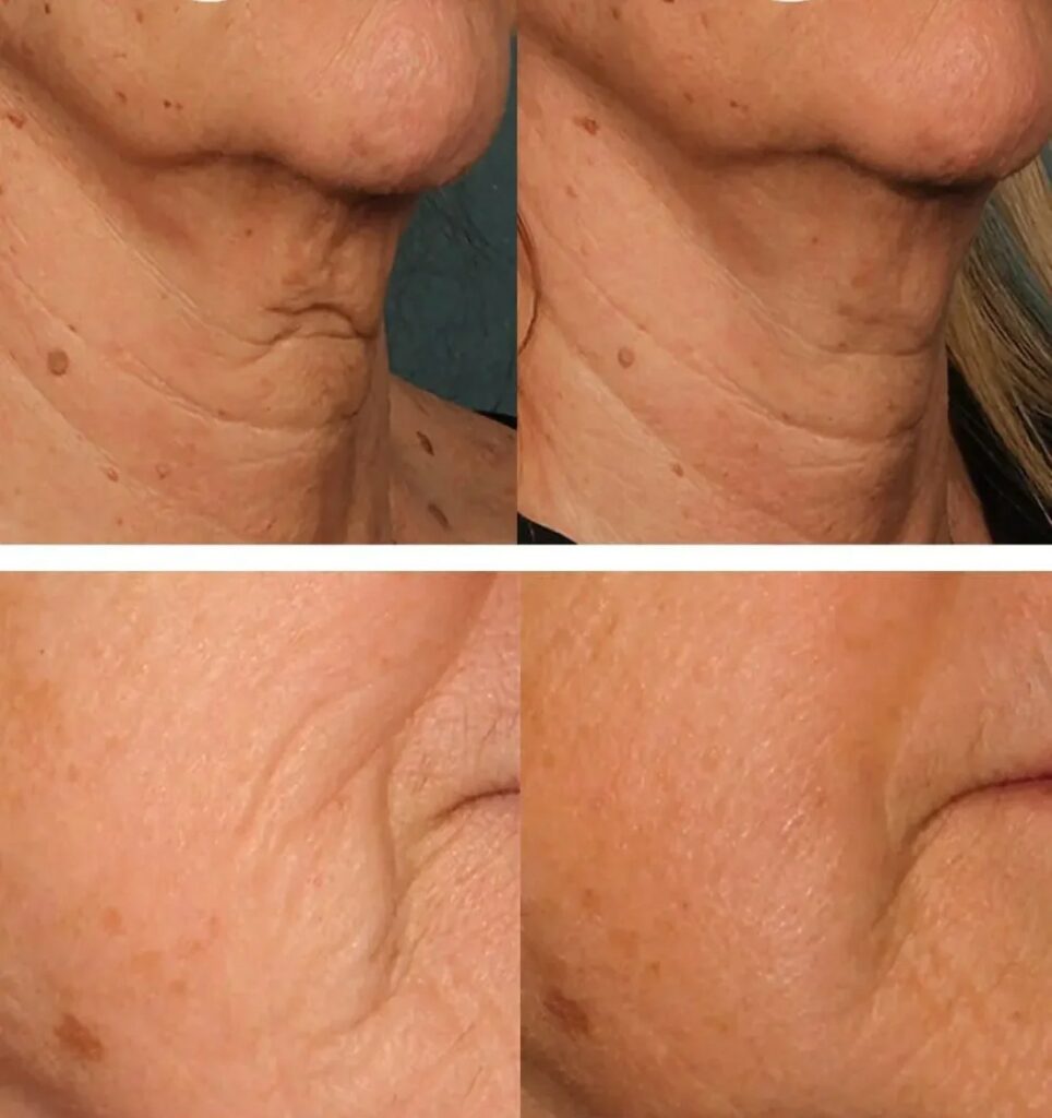 before and after photo of Sofwave treatment at Atomic Dermatology and Med Spa