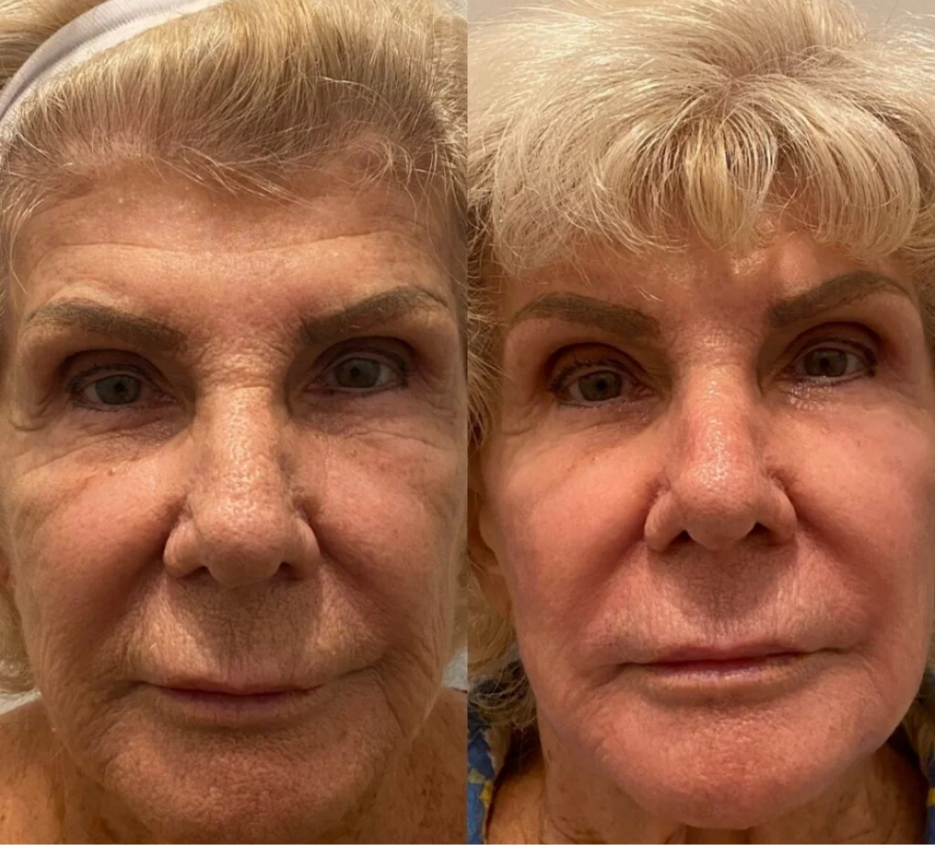 a photo of a before and after the Phoenix C02 treatment Atomic Dermatology and Med Spa