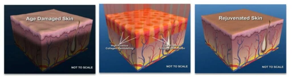 a presentation on how Phoenix C02 treatment works Atomic Dermatology and Med Spa